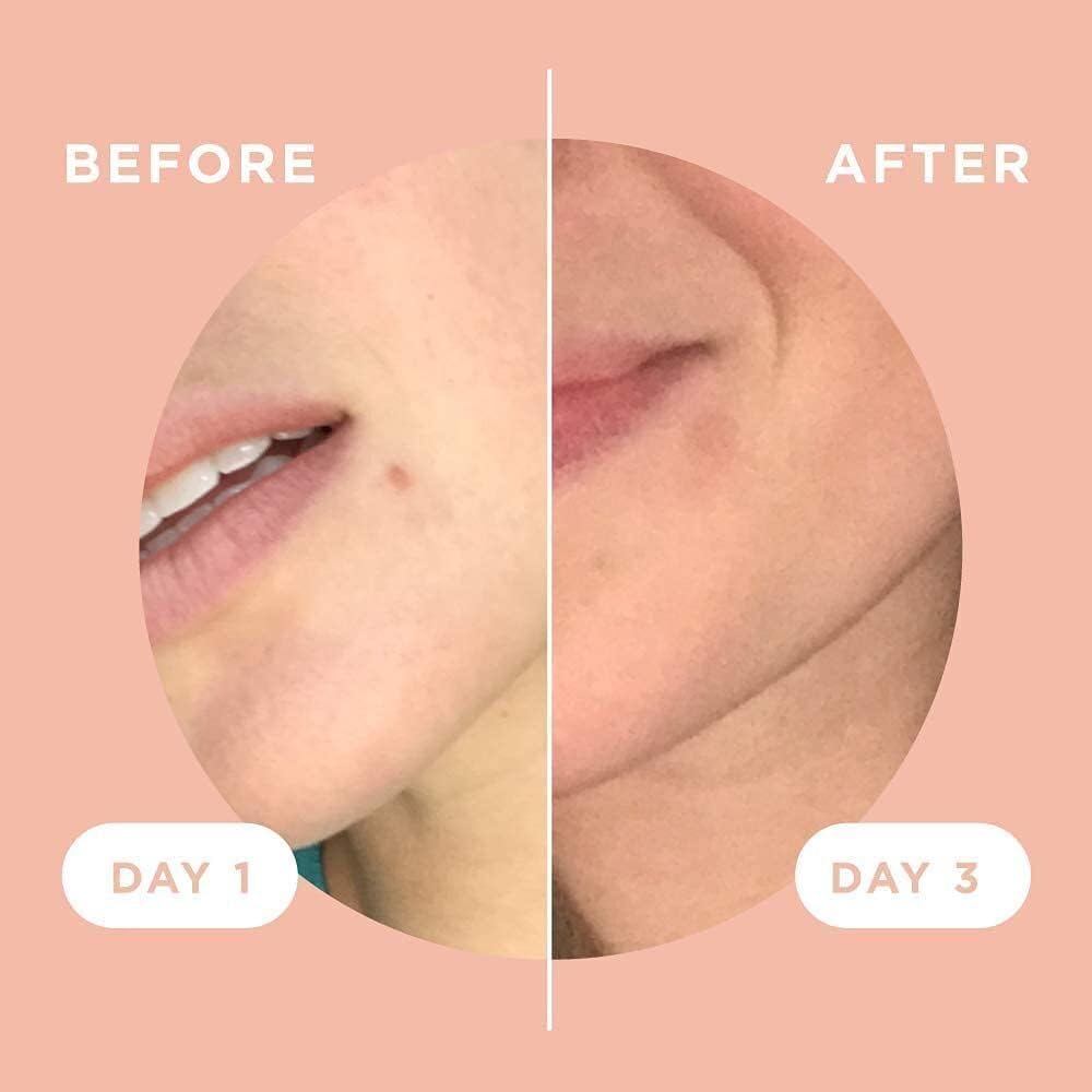 ZitSticka Killa Kit | Self-Dissolving Microdart Patch for Covering Zits and Spots, Stickers for Face and Skin, Vegan and Cruelty Free (8 Pack)