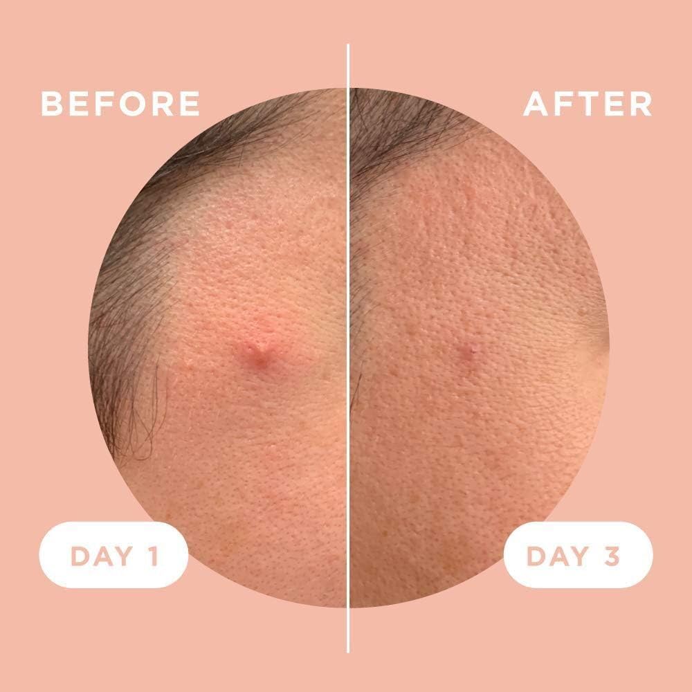 ZitSticka Killa Kit | Self-Dissolving Microdart Patch for Covering Zits and Spots, Stickers for Face and Skin, Vegan and Cruelty Free (8 Pack)