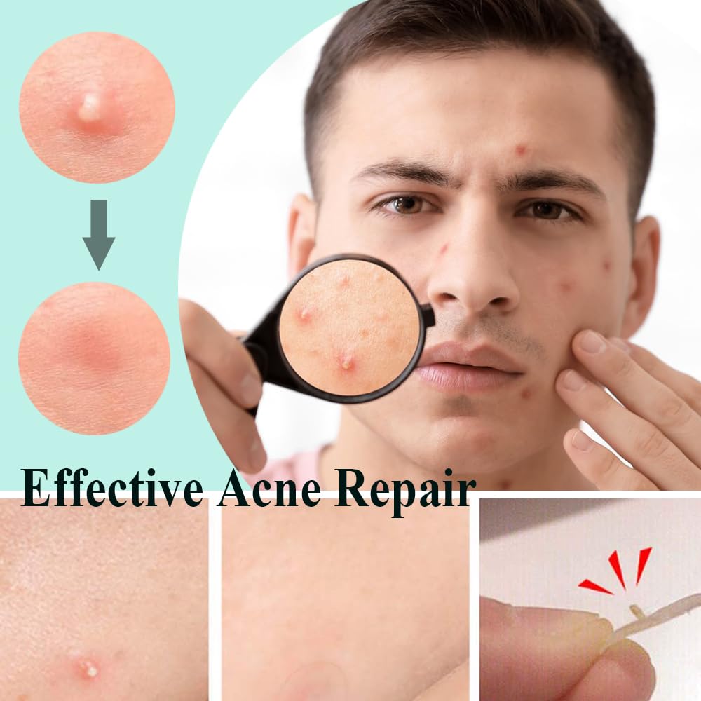 Zemolo 600pcs Pimple Patches Hydrocolloid Acne Stickers with Tea Tree Oil Spot Cover Patches Day & Night Whiteheads Acne Absorbing Blemish Patches Invisible Spot Treatment Stickers
