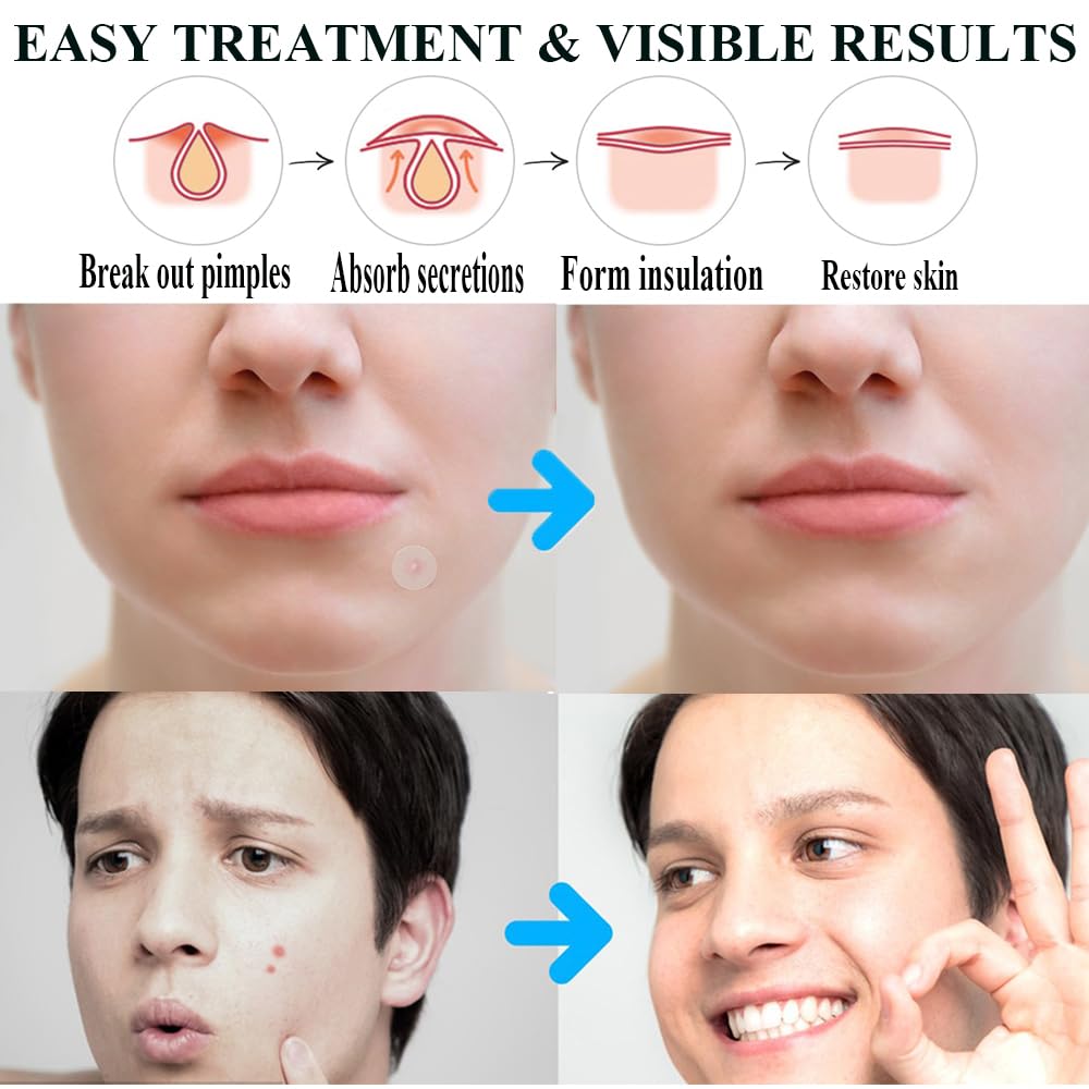 Zemolo 600pcs Pimple Patches Hydrocolloid Acne Stickers with Tea Tree Oil Spot Cover Patches Day & Night Whiteheads Acne Absorbing Blemish Patches Invisible Spot Treatment Stickers