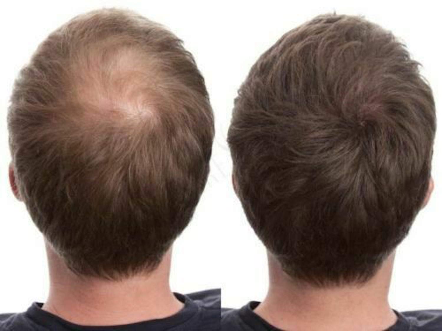 100% Natural Keratin Hair Fibre Refill For Hair Loss - Alopecia & Chemotherapy (100g, Medium Brown)