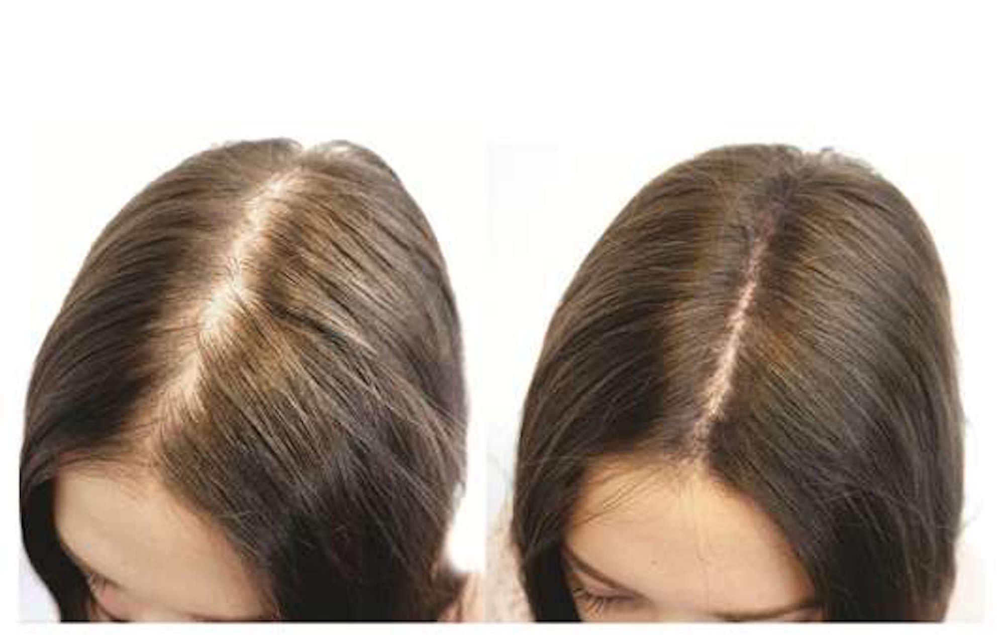100% Natural Keratin Hair Fibre Refill For Hair Loss - Alopecia & Chemotherapy (100g, Black)
