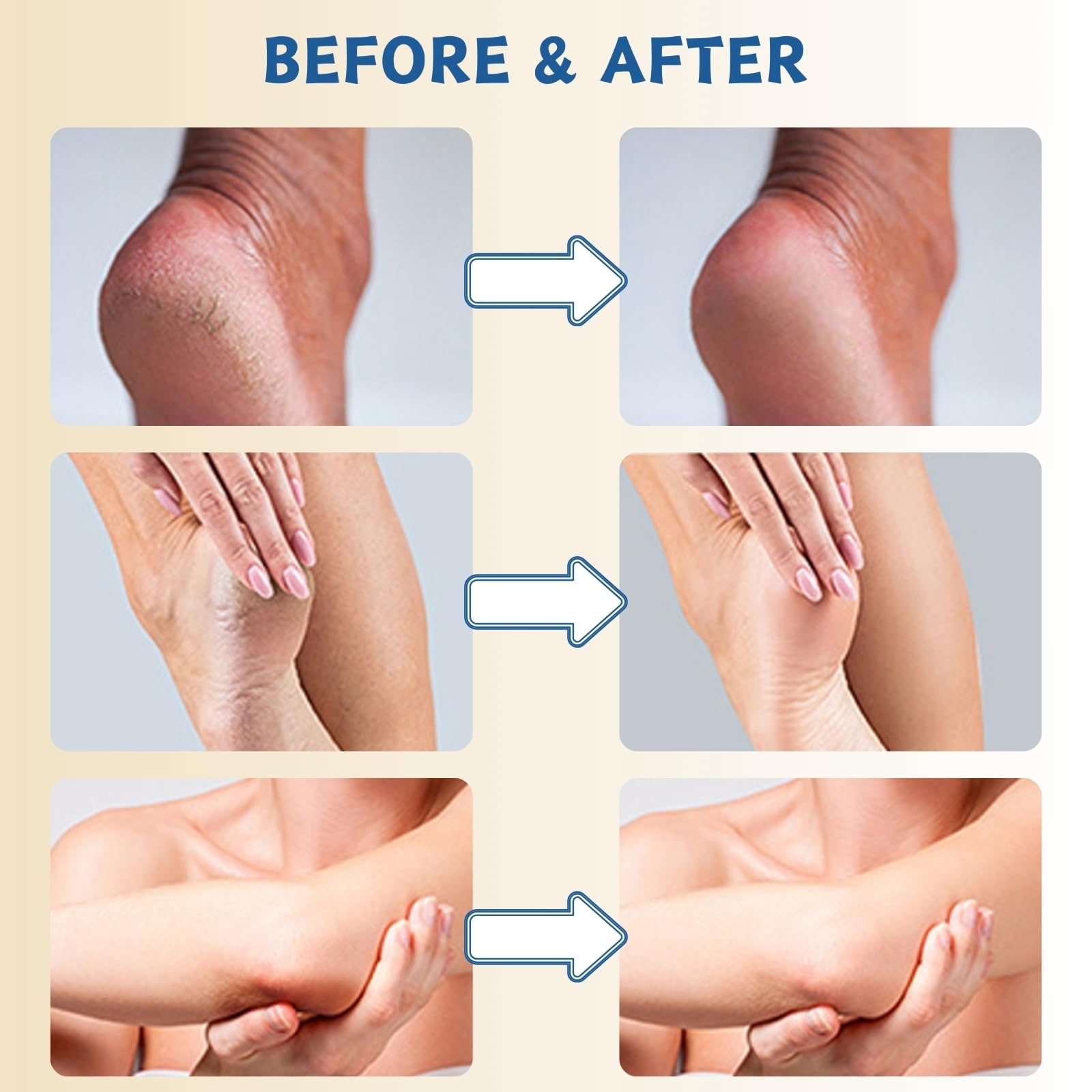 Urea Cream 60 Percent for Feet - Urea Foot Cream - Foot Cream for Cracked Heels and Dry Skin - Cracked Heel Repair Cream - Skin Care Hands & Feet - Foot Moisturiser (60% Urea Foot Creams)
