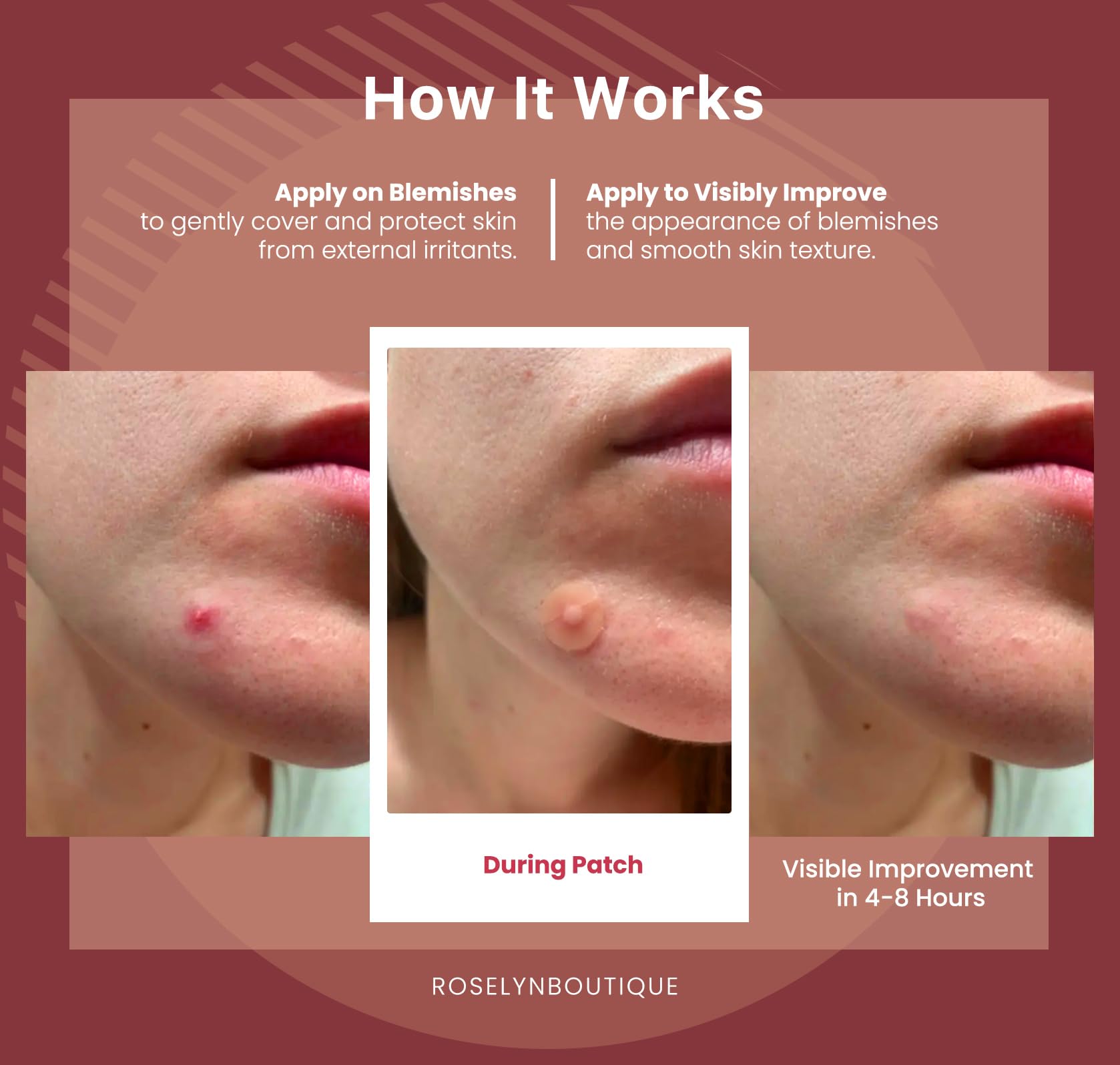 ROSELYNBOUTIQUE Pimple Patches for Face - Hydrocolloid Acne Patches For Zits Blemishes Pore Strips - Vegan Cruelty-Free Skincare Products Skin-Friendly (150 Dots)