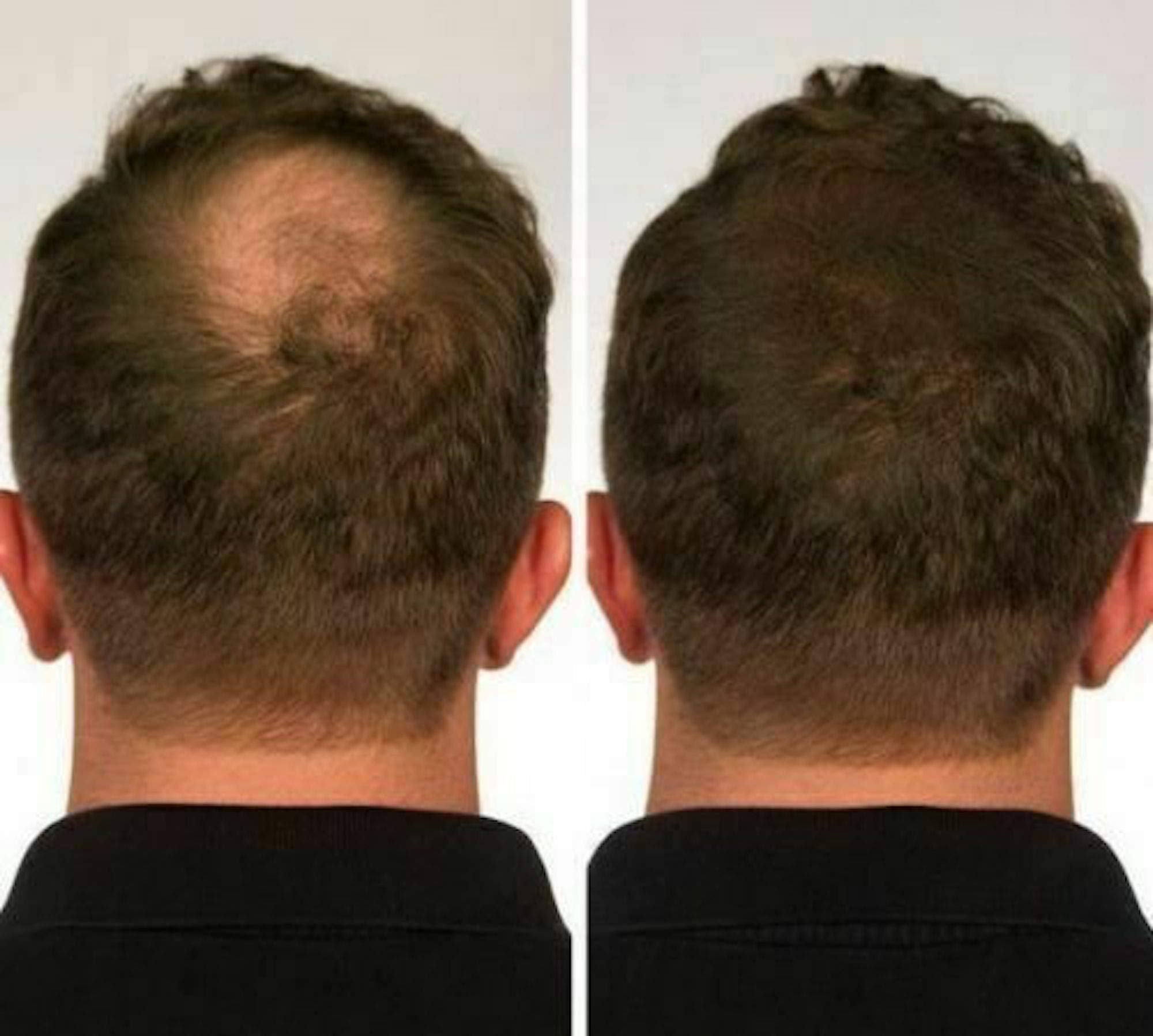 100% Natural Keratin Hair Fibre Refill For Hair Loss - Alopecia & Chemotherapy (100g, Dark Brown)
