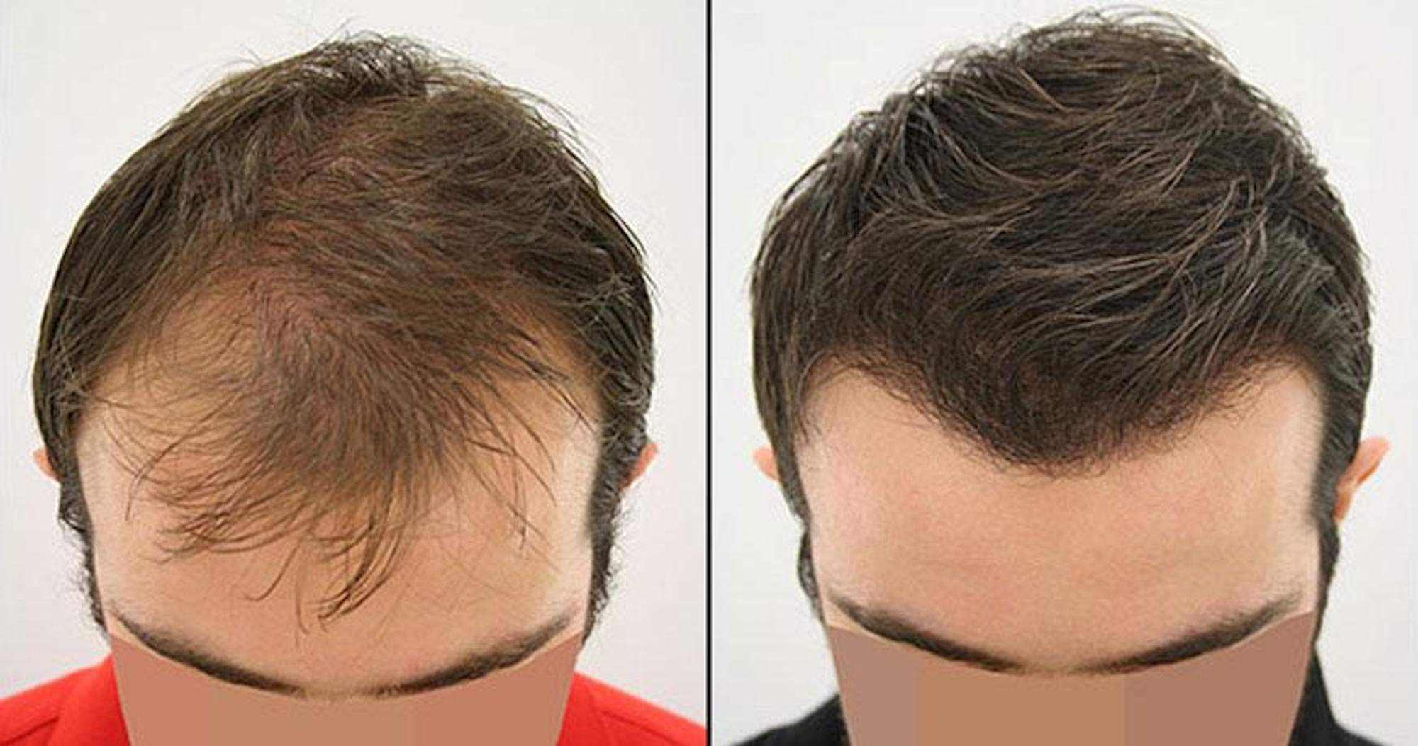 100% Natural Keratin Hair Fibre Refill For Hair Loss - Alopecia & Chemotherapy (100g, Dark Brown)
