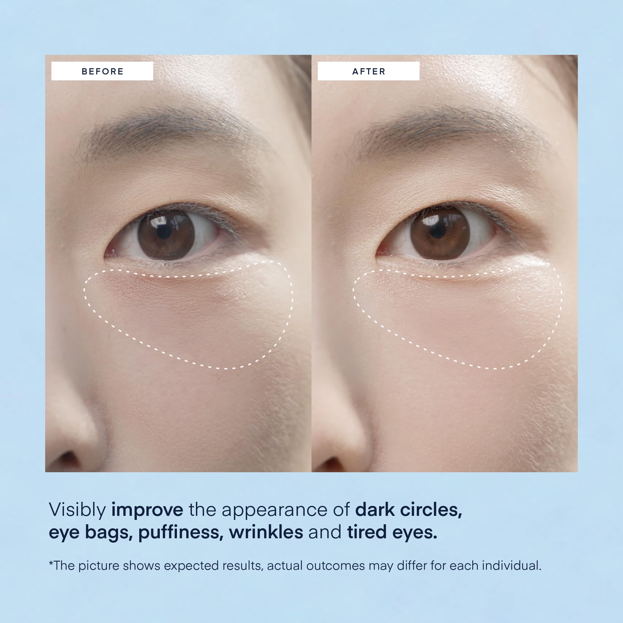 Korean Under Eye Gel Patches: Eye Masks for Puffy Eyes Dark Circles & Wrinkles with Caffeine Hyaluronic Acid & Niacinamide - Brightening Hydrating & Cooling Hydrogel Skincare Pads - 30 Pairs, Vegan