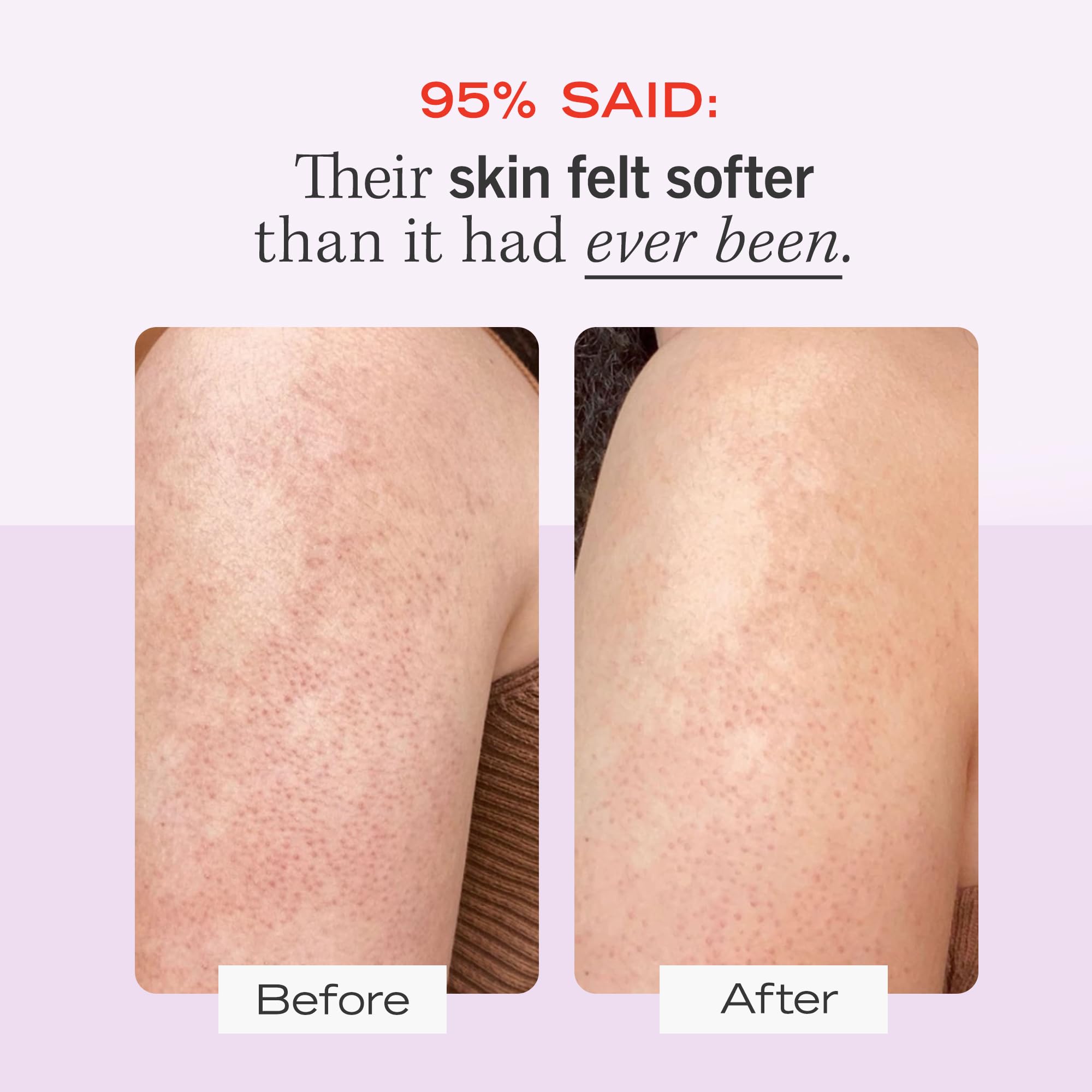First Aid Beauty - KP Bump Eraser Body Scrub with 10% AHA, Keratosis Pilaris Skin Exfoliater with Glycolic and Lactic acids, Helps Reduce Chicken Skin Bumps, Safe for Sensitive Skin,226g + Bonus 56.7g