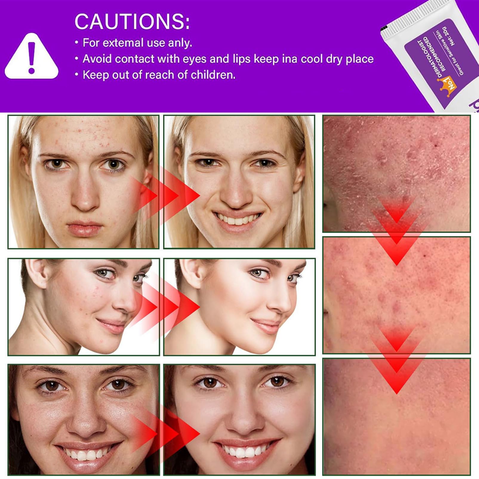 (2PCS) Acid Face Cream, Acid 12% Facial Serum Cream, Niacinamide & Vitamin C for Redness Face, Dark Spot, Rosacea,Acne,Face Skin Care Beauty Products,Skincare for All Skin Types 20G (2)