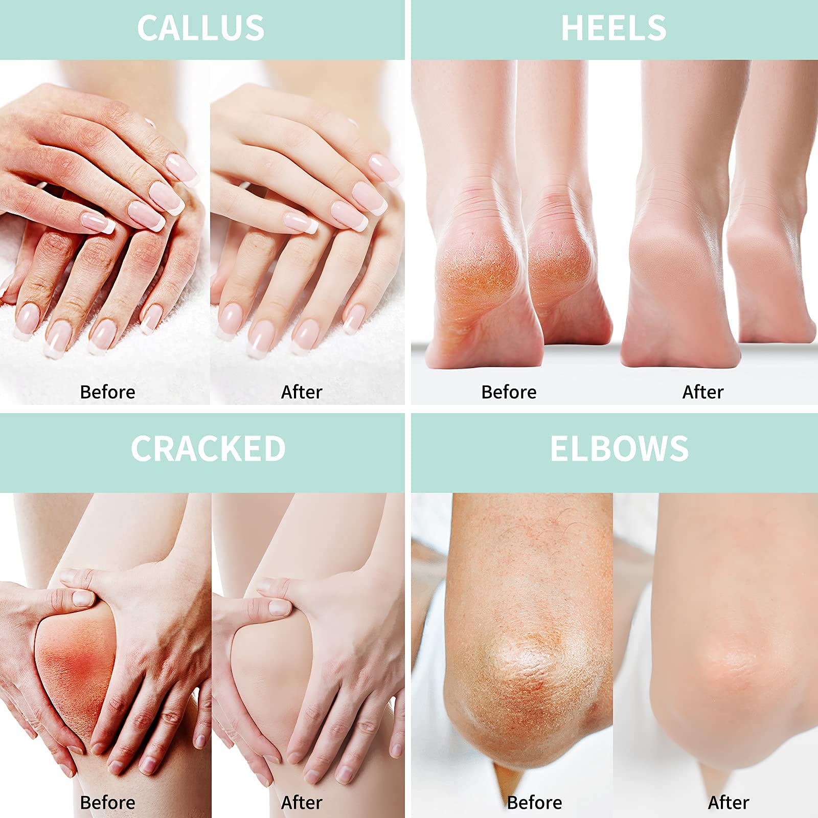 2 Packs Urea Foot Cream 40 Percent Plus 2% Salicylic Acid 150g ||Foot Cream with Urea with Hyaluronic Acid, Tea Tree & Aloe Vera for Deep Moisturizing, Callus Soften