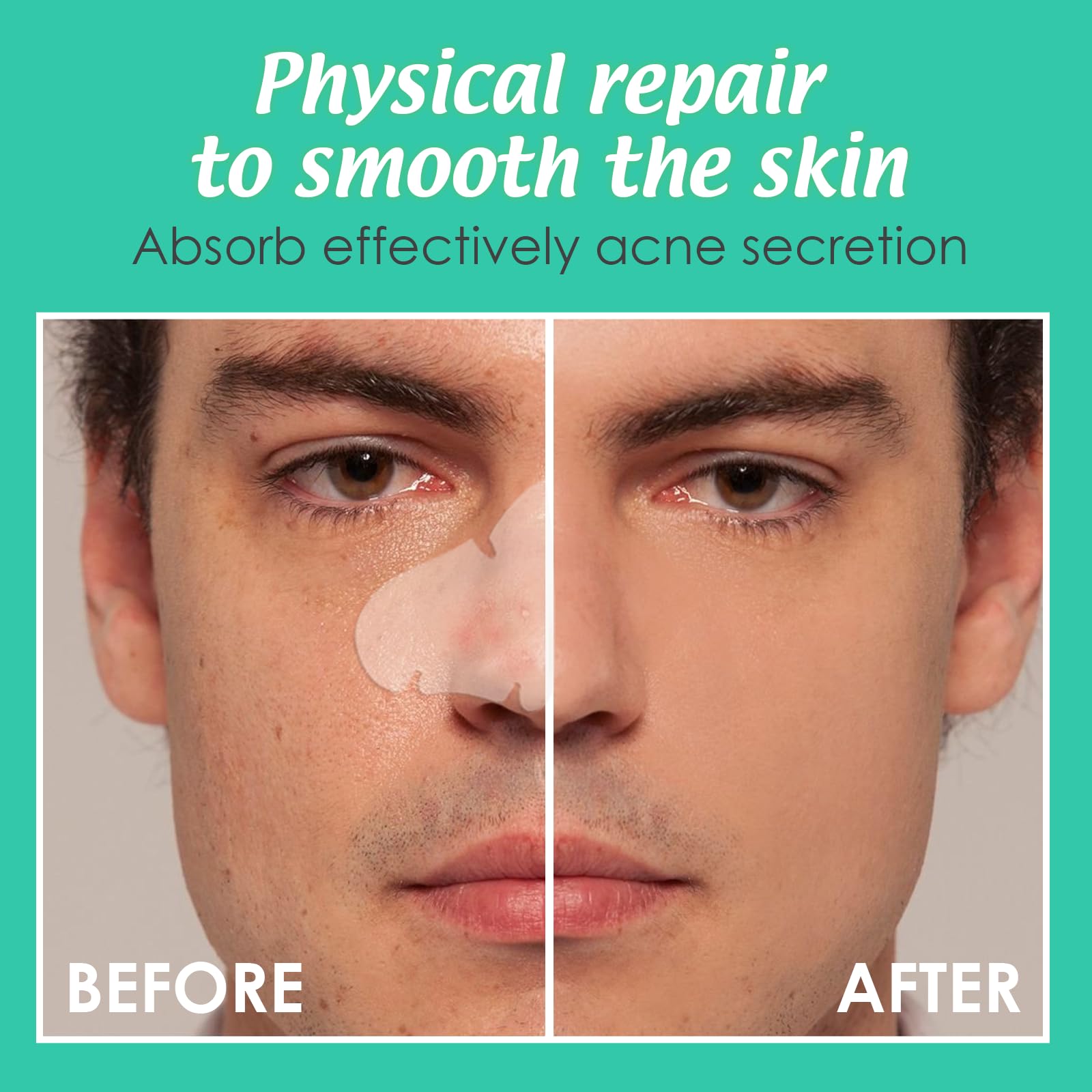 Pimple Patches Nose Large Spot Patches Spot Stickers Acne Treatment Absorbing Cover Invisible Blemish Cover Acne Dots for Fast Acting Skincare (20 Nose)