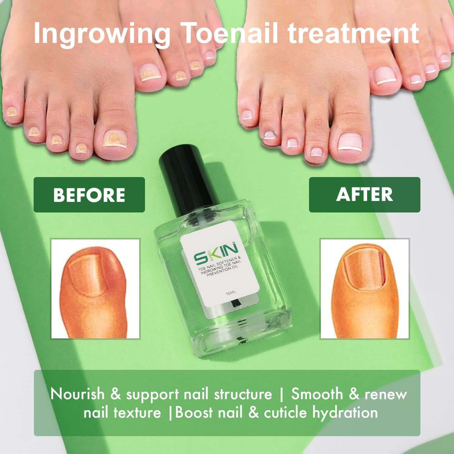 Skinapeel Toe Nail Softener & Ingrowing Toenail Prevention Oil 15ml - Manicure Nourisher Cuticle Revitalizer Natural Treatment