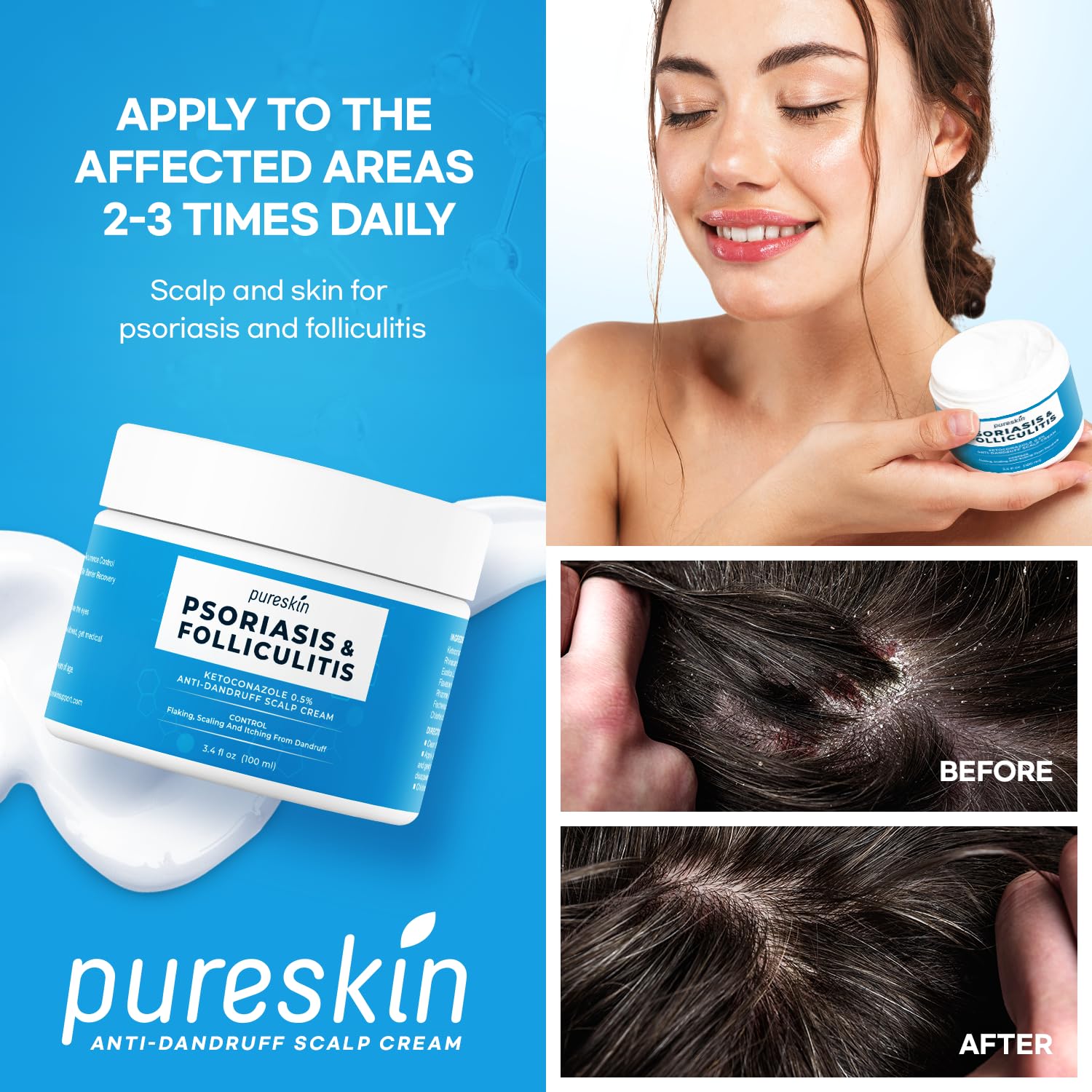 PURESKIN Psoriasis Scalp Treatment Cream - Extra Strength for Scalp Psoriasis Folliculitis - Controls Itching Flaking Stubborn Dandruff 3.4 Oz