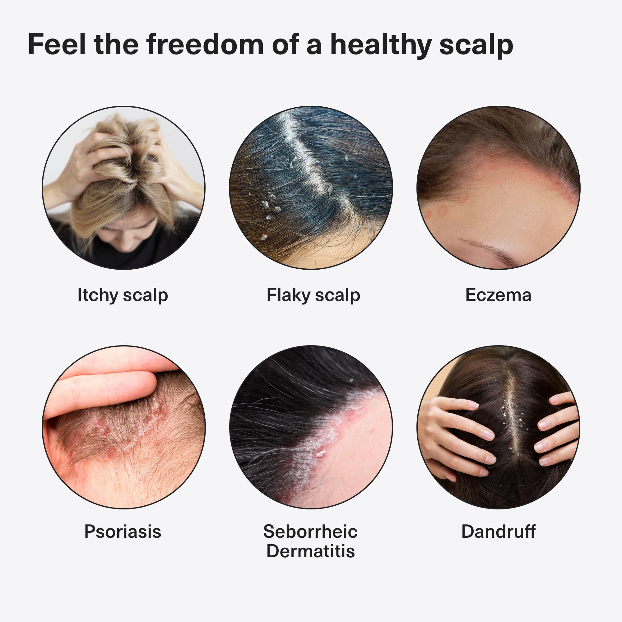 Healpsorin Psoriasis Anti Dandruff Shampoo. Flaky Scalp Psoriasis Treatment. Helps with Eczema, Dermatitis & Itchy Dry Scalp. Salicylic Acid Shampoo. Contains Dermosoft® 1%. 500ml