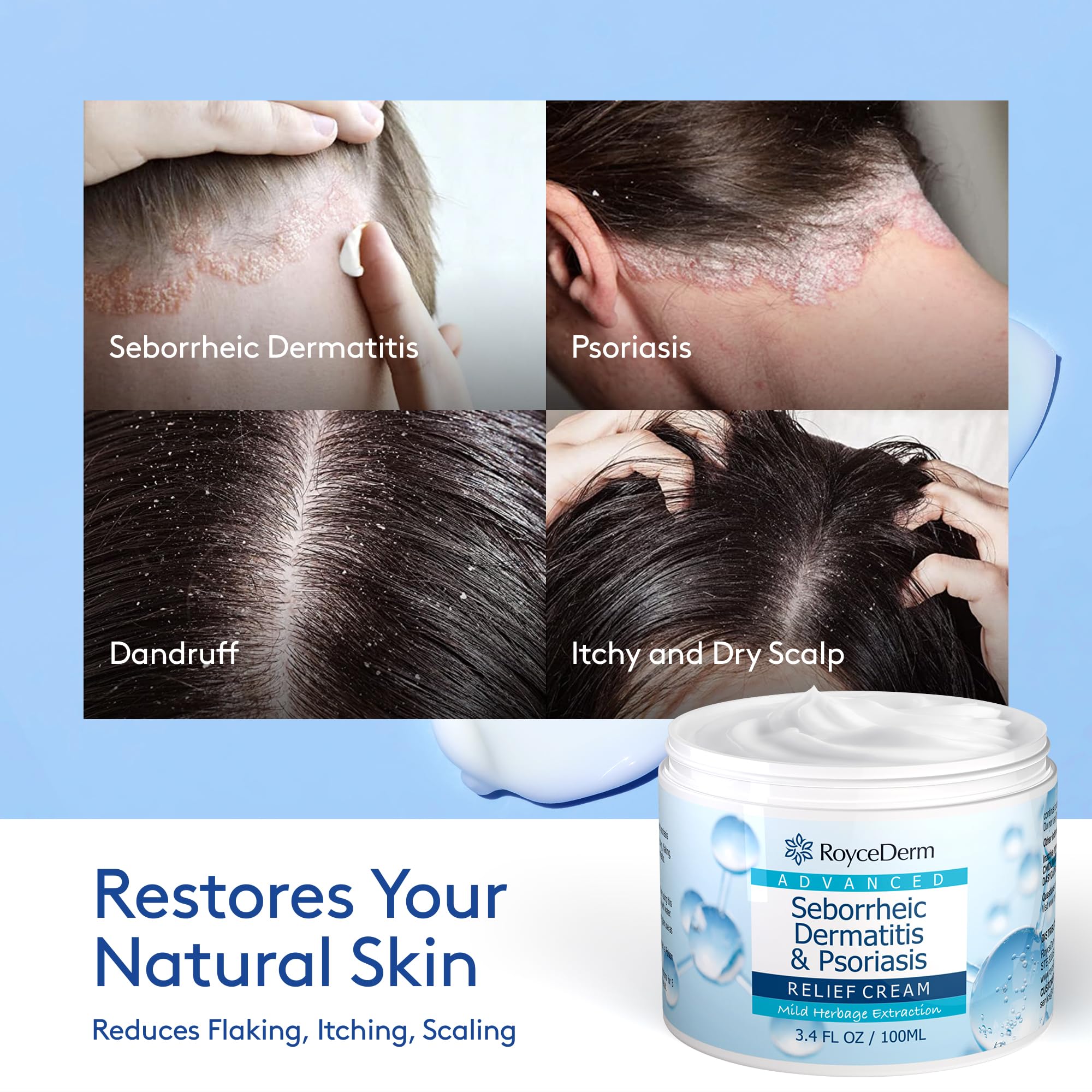 Seborrheic Dermatitis & Psoriasis Cream, Scalp Relief for Psoriasis, Folliculitis, Dry Scalp, Dandruff, Seborrheic Dermatitis, Anti-Itch Cream, Provides Soothing Relief