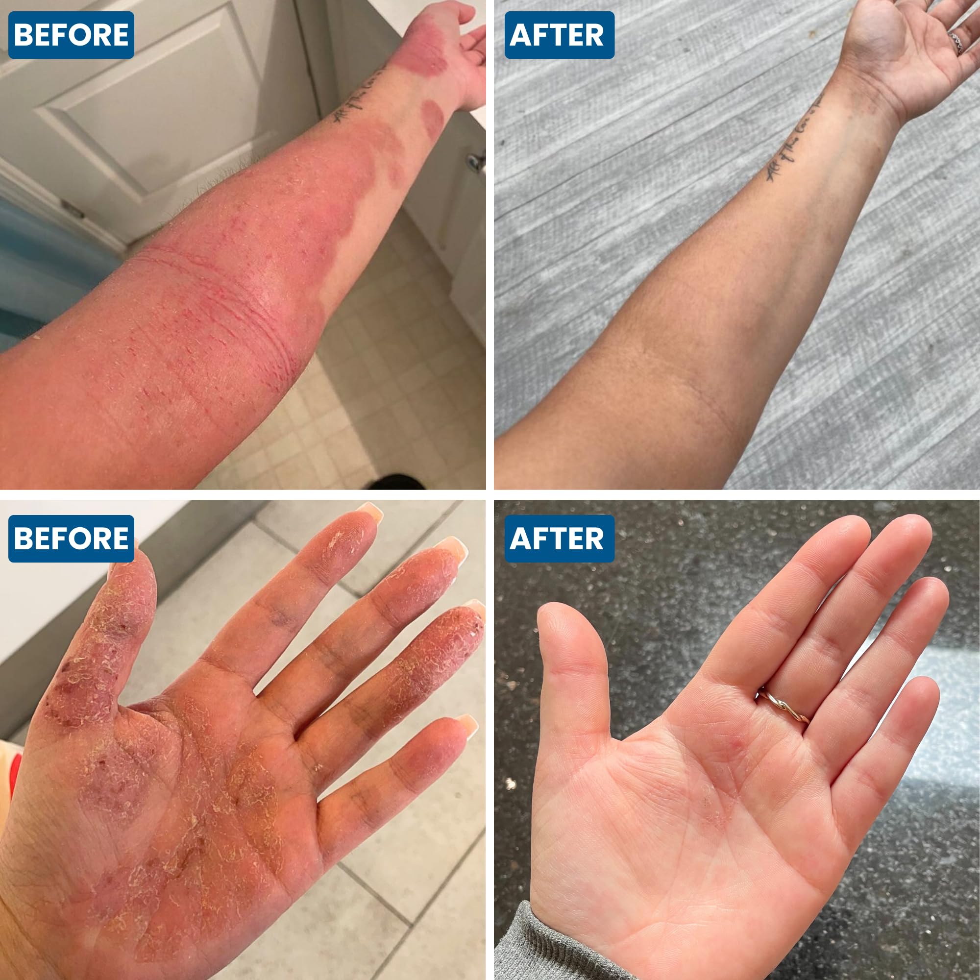 Grahams Natural C+ Eczema Cream - Clinically Proven Eczema Cream for Dry Skin, Inflammation, Dermatitis & Itchy Skin Relief for Adults - with Manuka Honey - Hypoallergenic & Steroid-Free (120g)