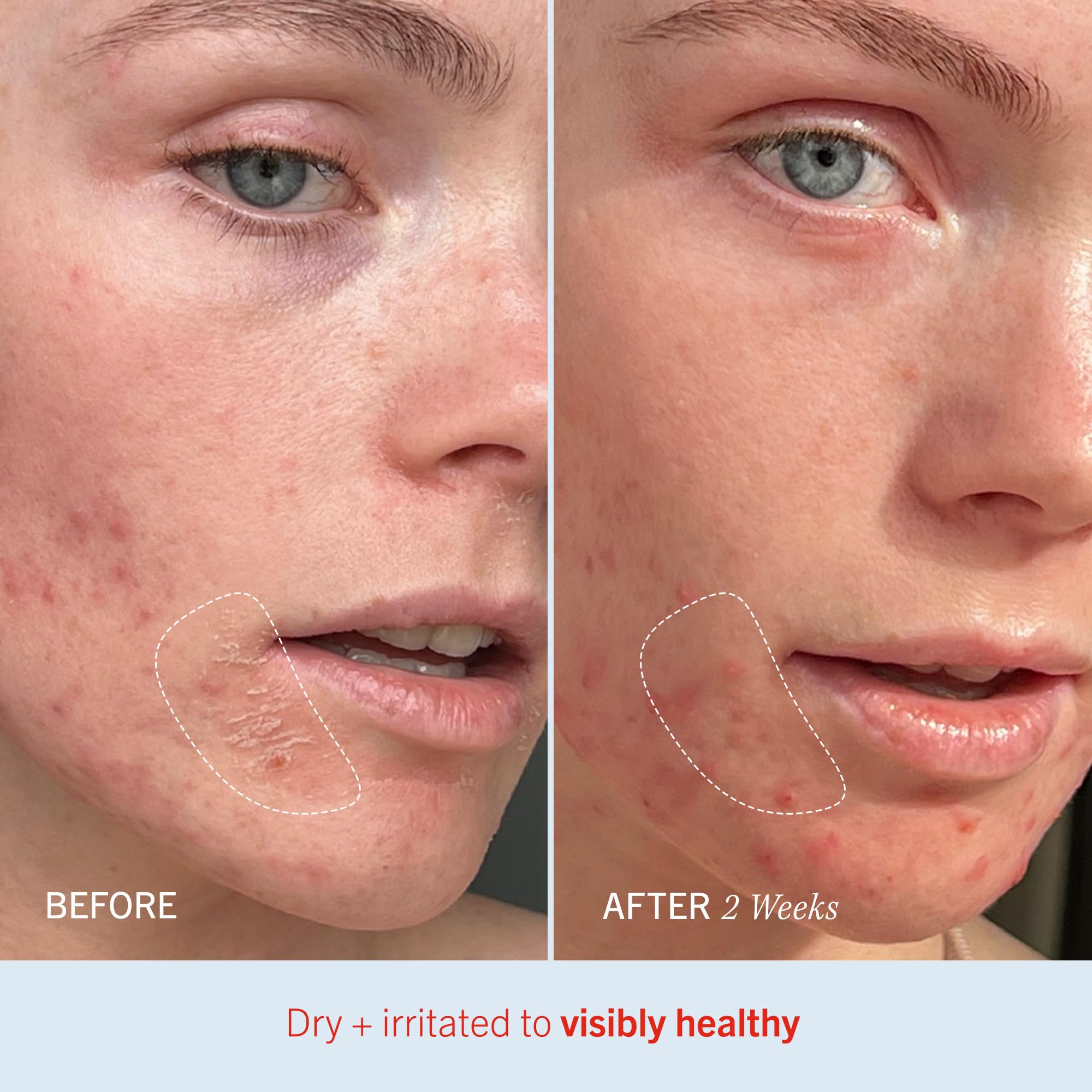 First Aid Beauty - Ultra Repair Cream, Intense Hydration Whipped Colloidal Oatmeal, Clinically Proven to Strengthen Skin Barrier in 7 Days & Helps Relieve Eczema,Luxury Face & Body Moisturiser, 170.1g