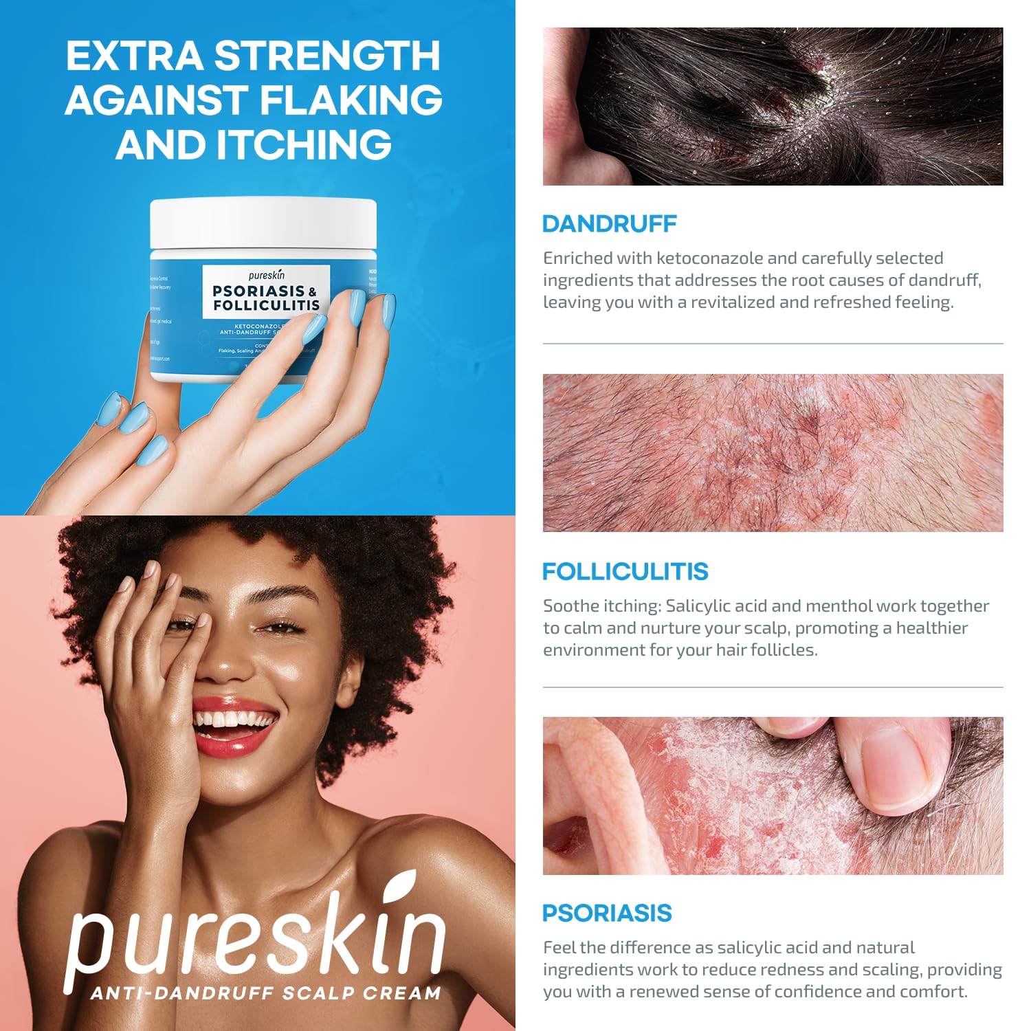 PURESKIN Psoriasis Scalp Treatment Cream - Extra Strength for Scalp Psoriasis Folliculitis - Controls Itching Flaking Stubborn Dandruff 3.4 Oz