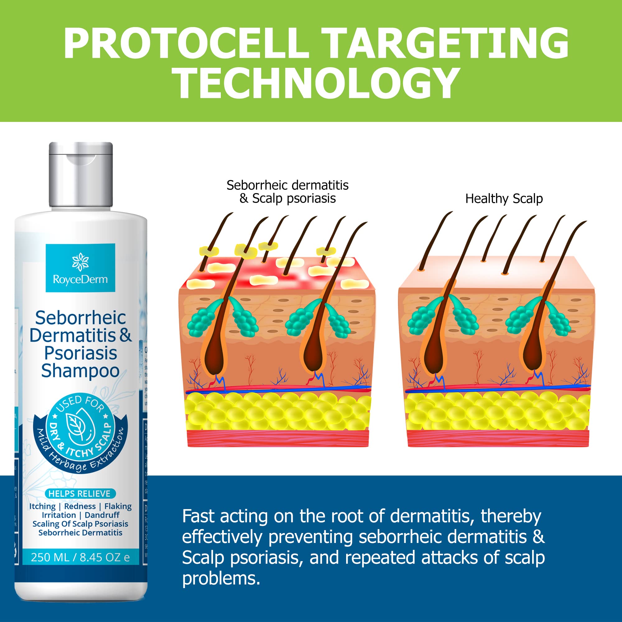 Roycederm Seborrheic Dermatitis Shampoo, Psoriasis Shampoo, Dandruff Shampoo, Folliculitis Shampoo, Scalp psoriasis Treatment, Seborrheic Dermatitis Treatment, Dandruff Treatment.