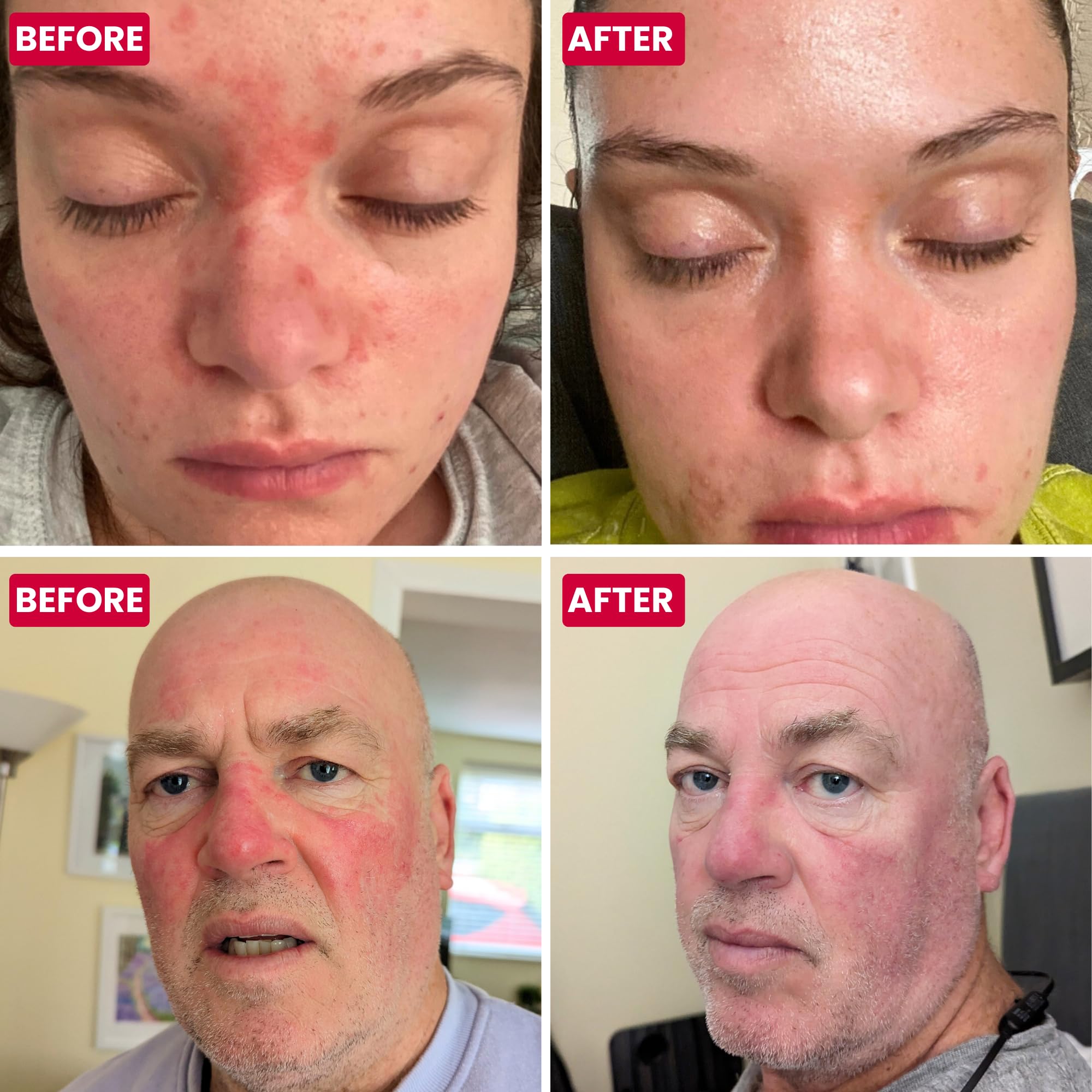 Grahams Natural Rosacea Cream - Clinically Proven Anti-Redness Treatment for Face to Soothe, Moisturise, Hydrate & Calm Sensitive Rosacea-Prone Skin | Hypoallergenic, Steroid-Free (75g)