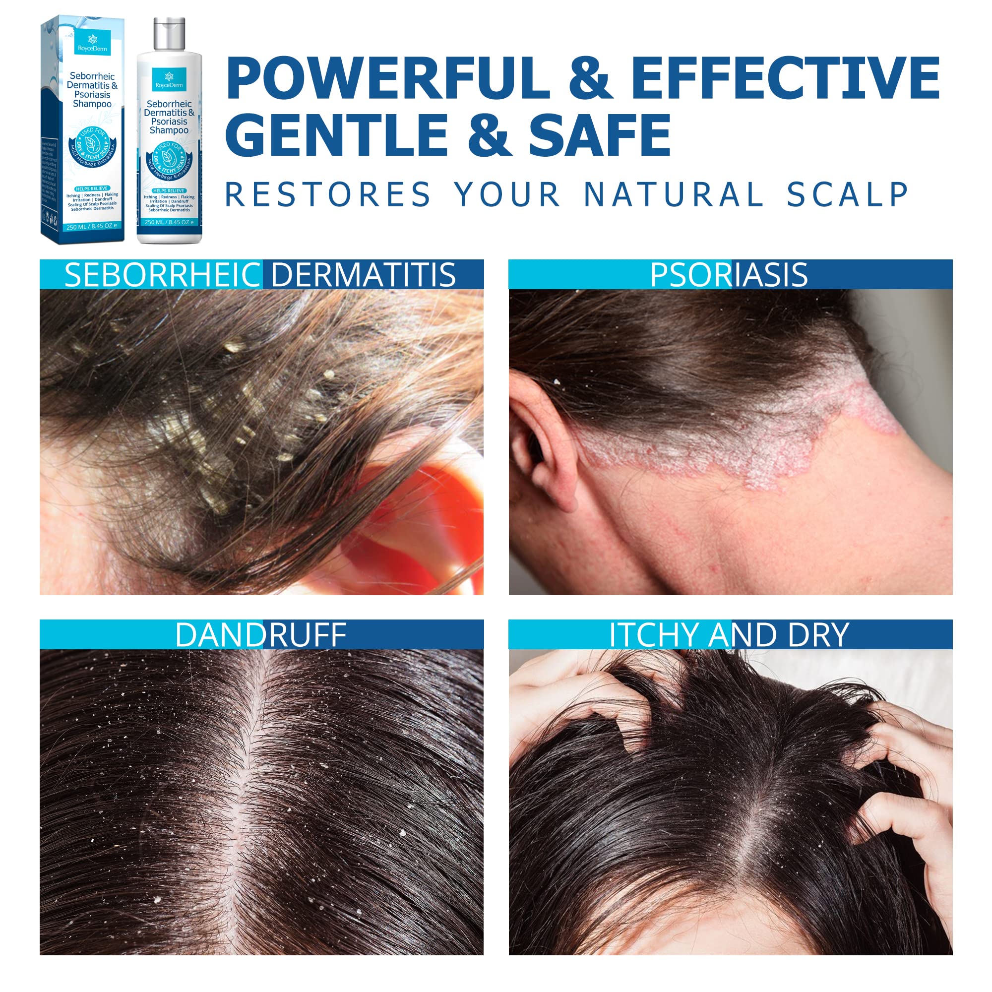 Roycederm Seborrheic Dermatitis Shampoo, Psoriasis Shampoo, Dandruff Shampoo, Folliculitis Shampoo, Scalp psoriasis Treatment, Seborrheic Dermatitis Treatment, Dandruff Treatment.