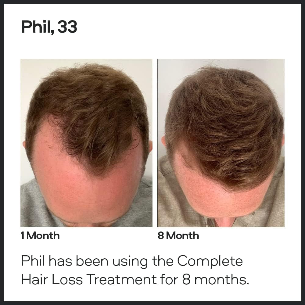 Sons Minoxidil 5% Cutaneous Solution & Dermaroller for Men. Hair Regrowth Treatment for Hair Loss & Thinning in Men. Microneedling Stimulates Collagen & Reactivates Shrunken Follicles. Made in Europe.
