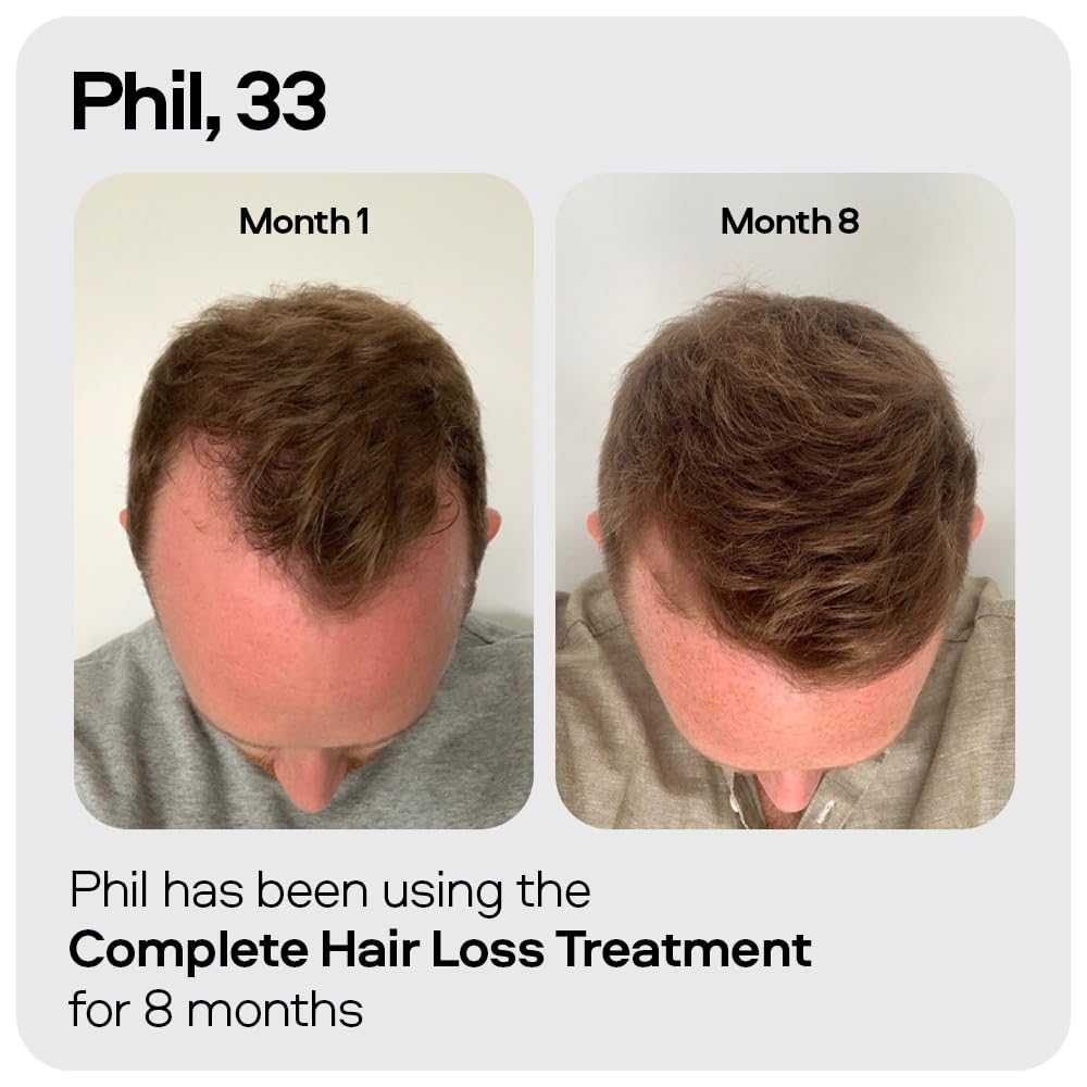 Sons Minoxidil 5% Cutaneous Solution & Dermaroller for Men. Hair Regrowth Treatment for Hair Loss & Thinning in Men. Microneedling Stimulates Collagen & Reactivates Shrunken Follicles. Made in Europe.