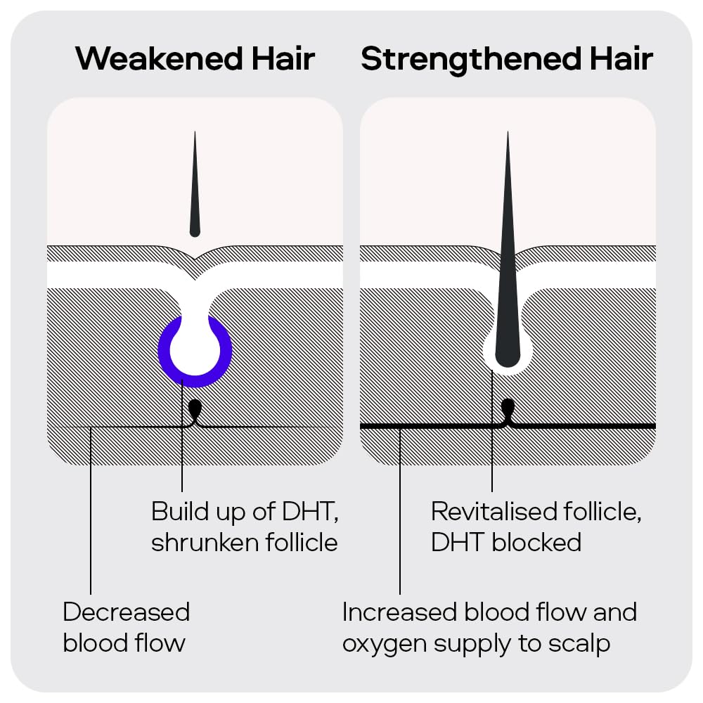 Sons Minoxidil 5% Cutaneous Solution & Dermaroller for Men. Hair Regrowth Treatment for Hair Loss & Thinning in Men. Microneedling Stimulates Collagen & Reactivates Shrunken Follicles. Made in Europe.