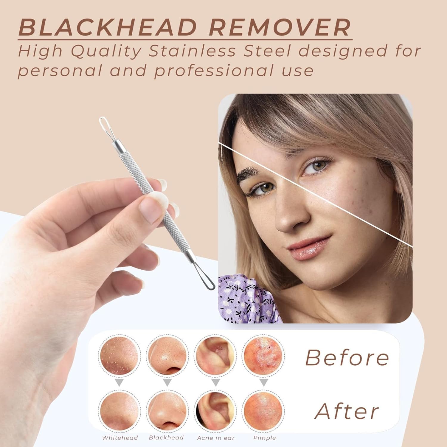 OCBA Blackhead Remover Professional Skincare Spot Treatment Blackhead Remover Tool for Blemish Comedone Whiteheads Pimple Popper with Double Sided Soft Touch and Anti-Slip Design